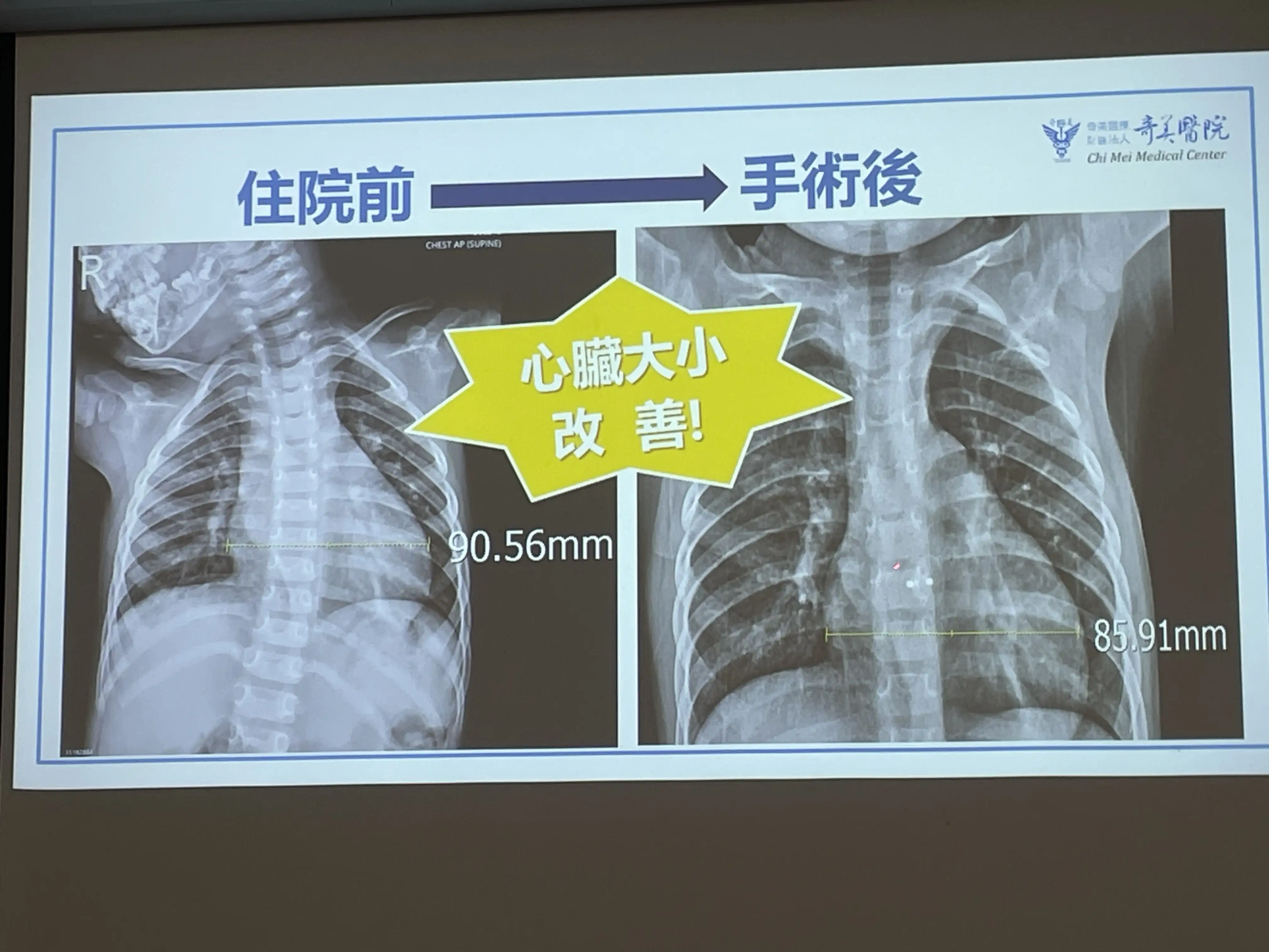 陳小妹妹接受微創心導管封堵術前後X光影像對比，可見術後心臟大小明顯改善。(圖/記者林怡孜攝)
