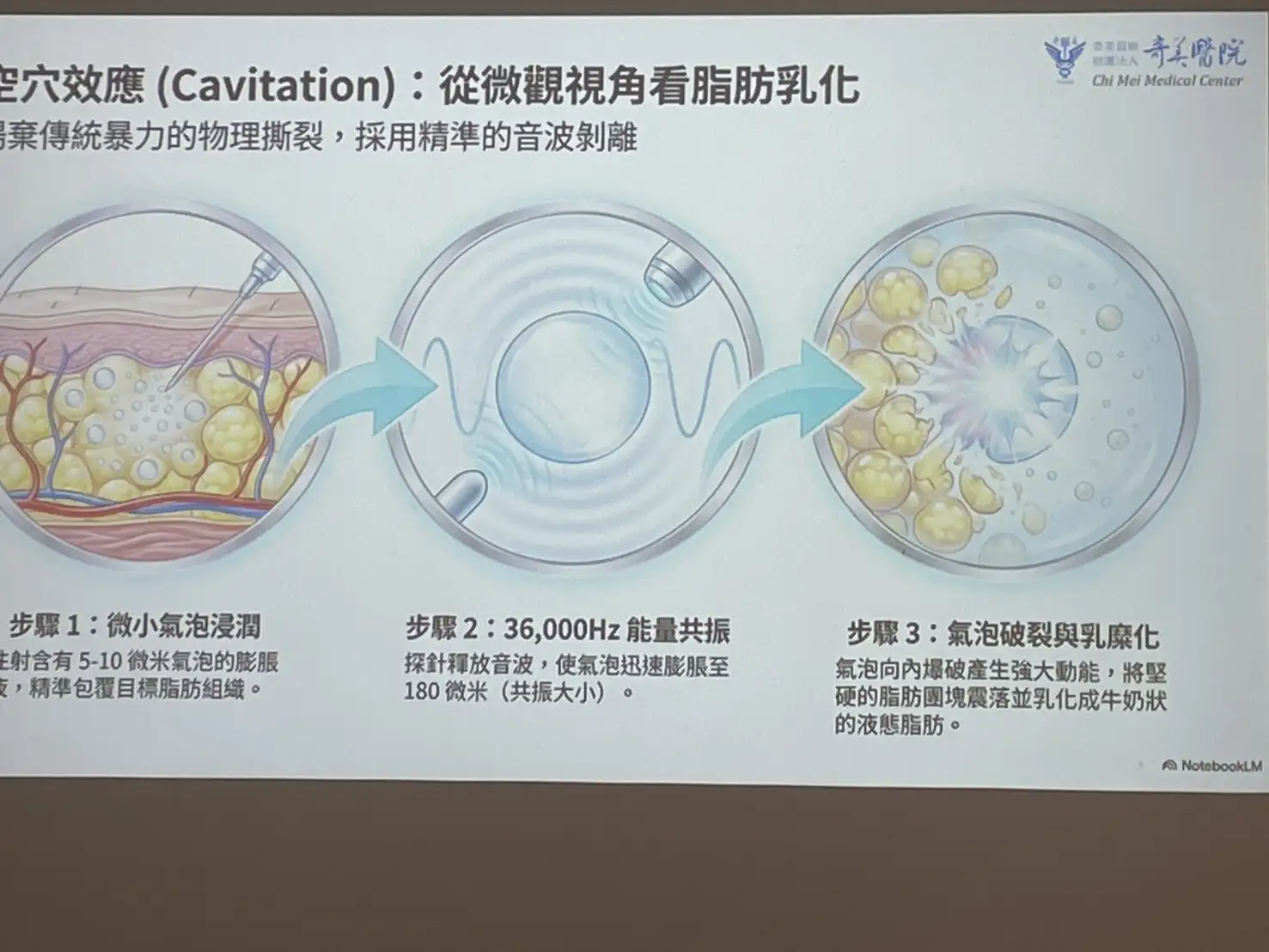 威塑超音波氣泡脂雕系統透過高頻超音波乳化脂肪，抽出的脂肪細胞完整性較佳，可進一步應用於自體脂肪回填。(記者林怡孜攝)
