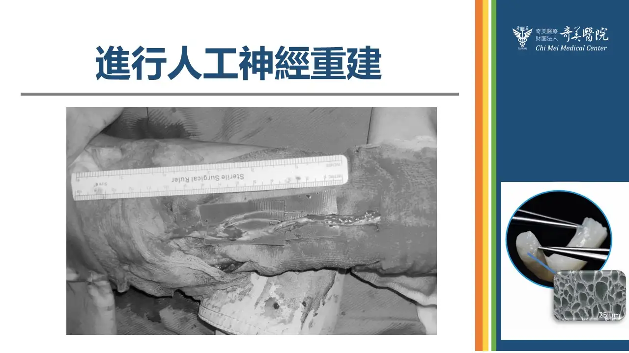 醫療團隊於顯微鏡下進行人工神經重建手術，透過橋接修復方式重建受損神經傳導路徑。(奇美醫院提供)