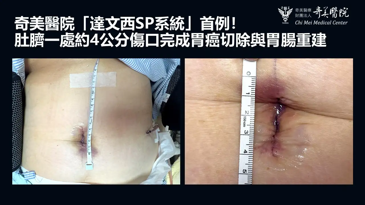 奇美醫院完成達文西SP系統首例胃癌次全胃切除手術，經由肚臍約4公分單一傷口完成腫瘤切除、淋巴廓清及胃腸重建，術後恢復良好。(圖/奇美醫院提供)