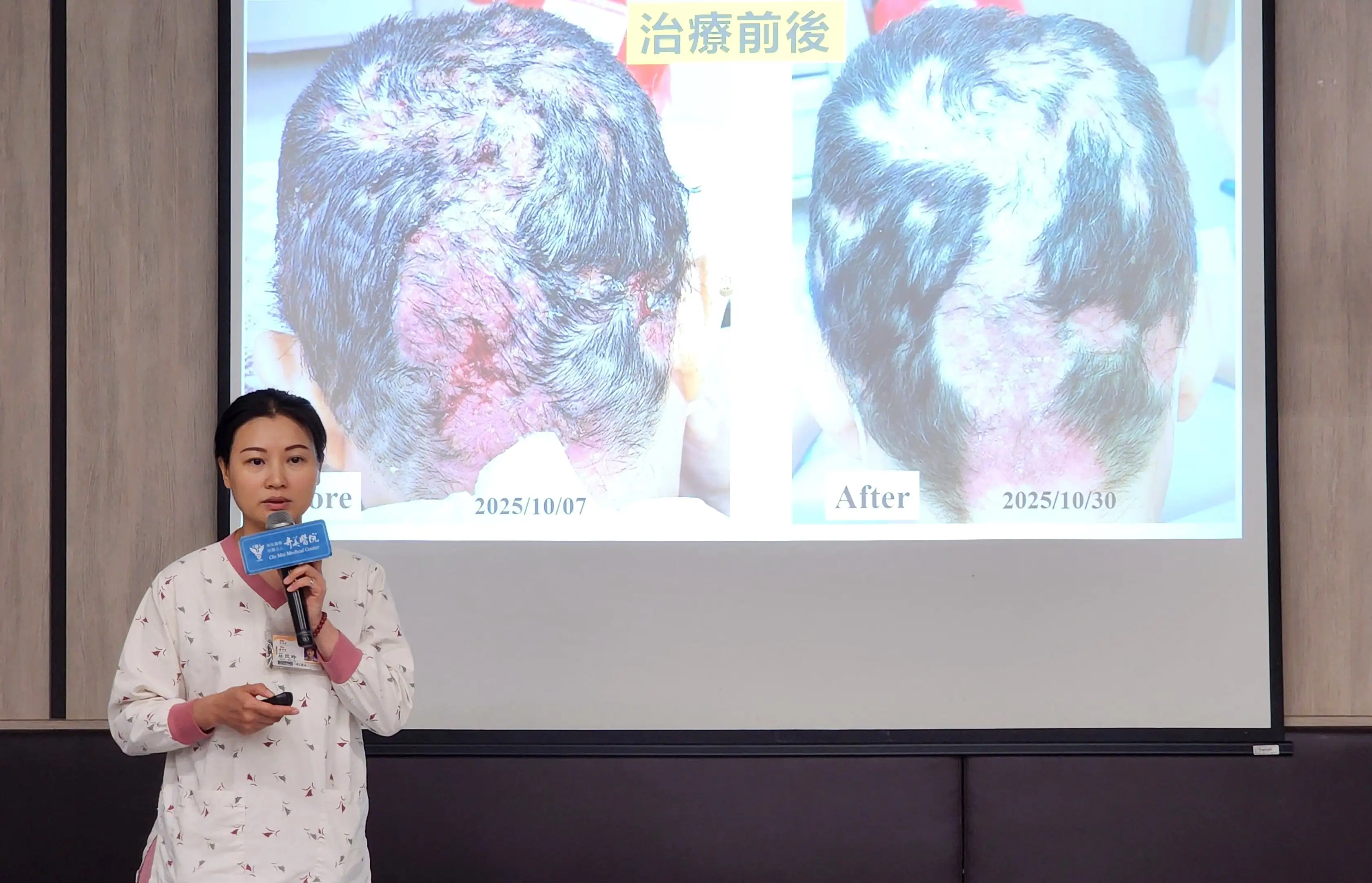 奇美醫院傷口照護中心傷口護理師莊玟玲分享「傷口衛生4步驟」，包括清潔、清創、重塑傷口邊緣及適當敷料選擇，透過專業清潔與感染控制，協助病人擺脫慢性發炎與反覆感染困擾。(圖/奇美醫院提供)