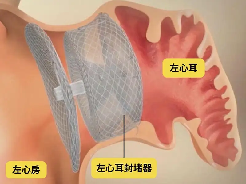 輔醫心血管醫學部心臟內科團隊，日前順利執行左心耳封堵術，左心耳示意圖。（圖／輔醫提供）