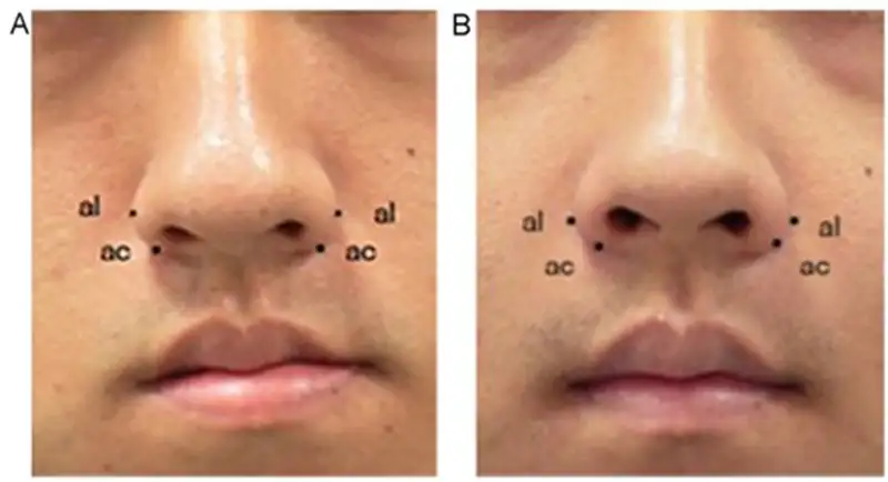 鼻翼基底縫合術式手術前後之外觀變化(A)手術前，(B)手術後。(圖/奇美醫院提供)