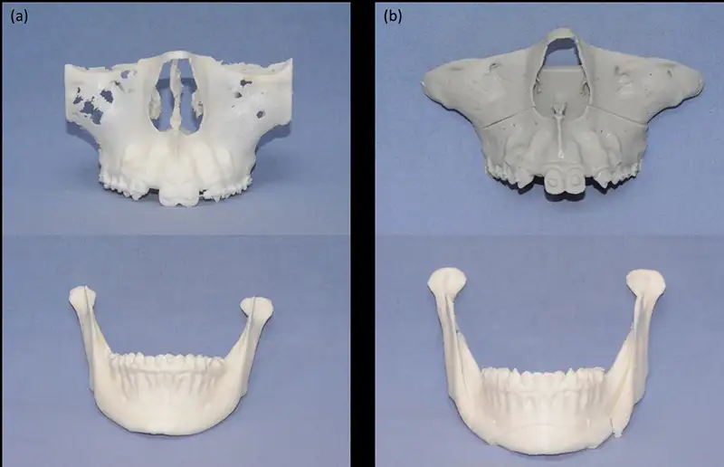 3D列印之顎骨模型(a)手術前，(b)手術後。(圖/奇美醫院提供)